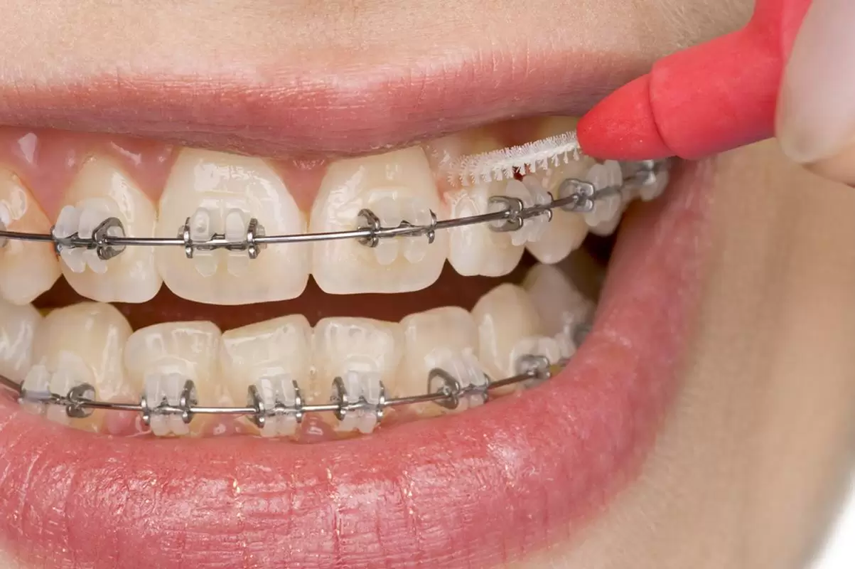 Invisalign clear aligner treatment