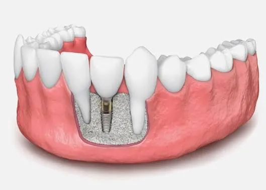 Bone grafting
