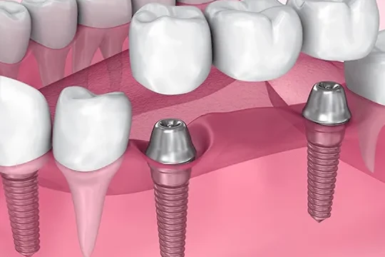 Dental implant-supported bridge