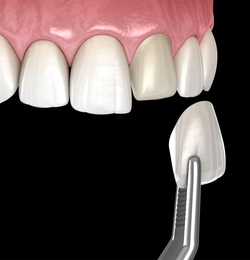 Dental veneers from a Hopkins dentist