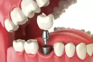Do dental implants hurt?