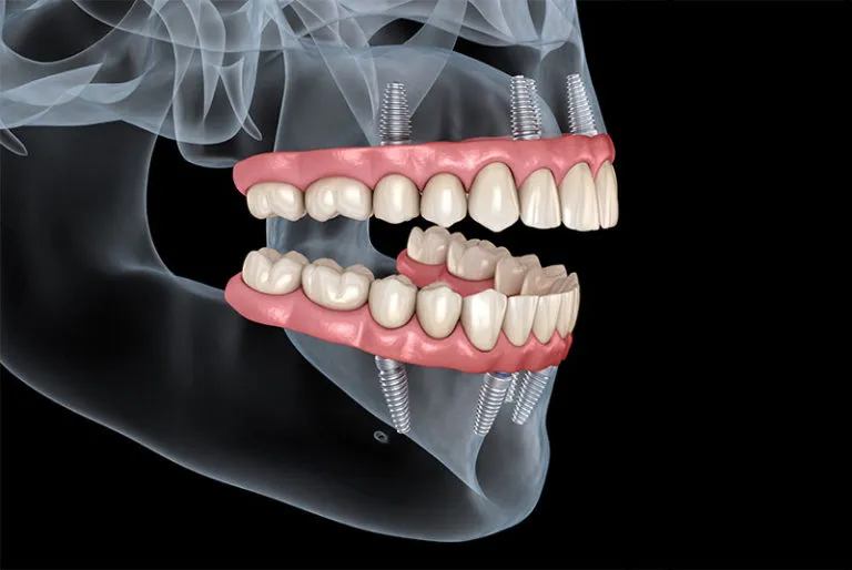 Full mouth dental implants