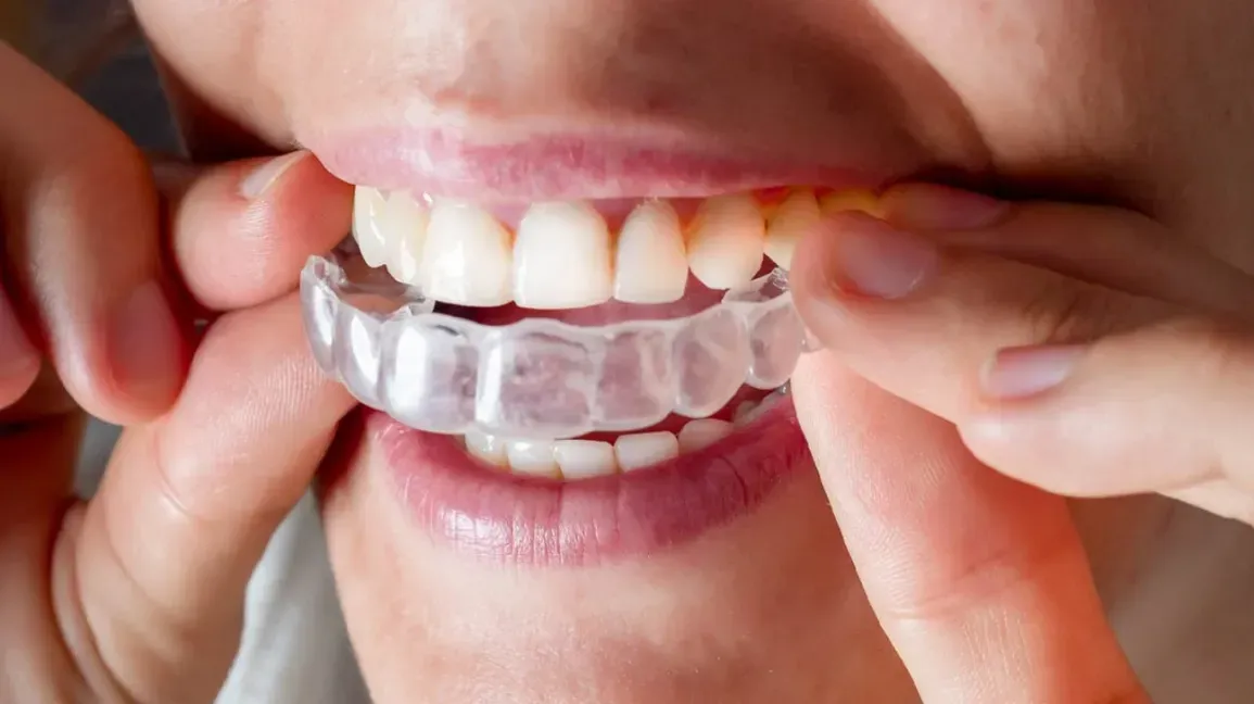 Invisalign, a braces alternative