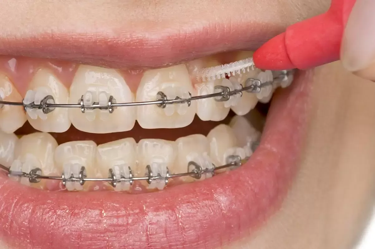 Orthodontic maintenance in Hopkins, MN