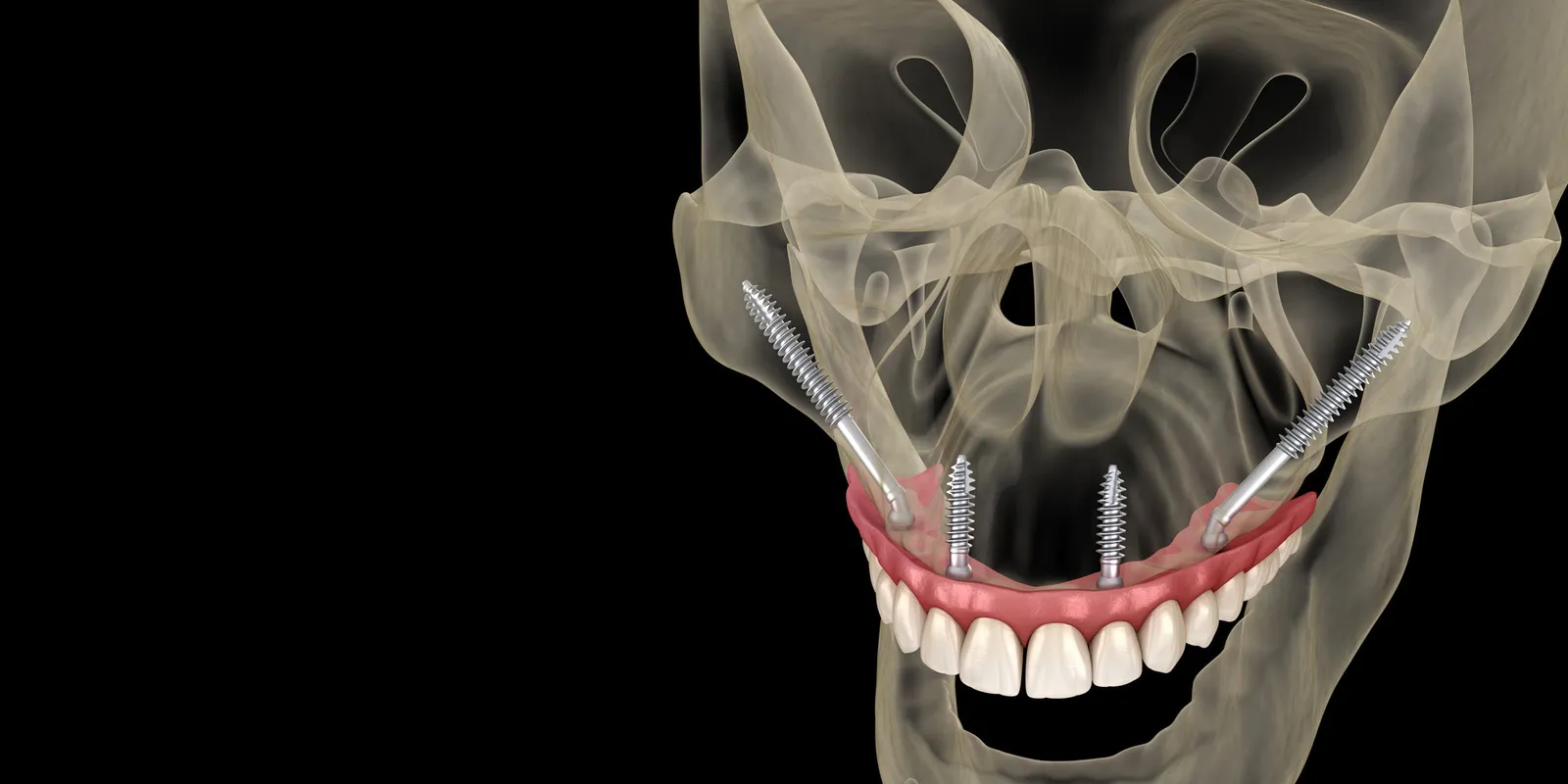 Zygomatic dental implants when there is no bone