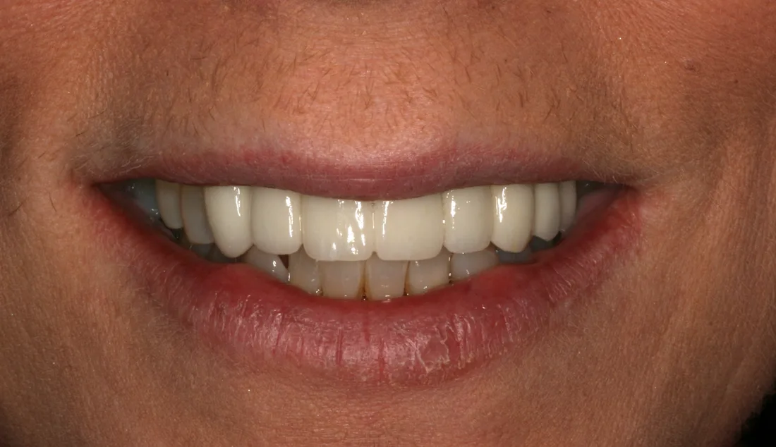 Valery: before and after