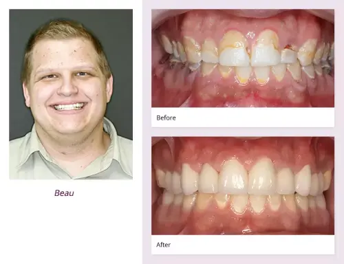 client-Beau-before-after