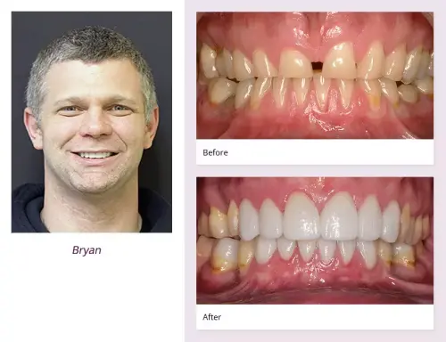 client-Bryan-before-after