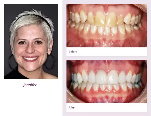 client-Jennifer-before-after