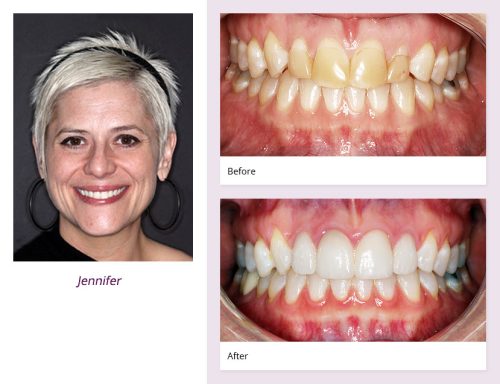 client-Jennifer-before-after