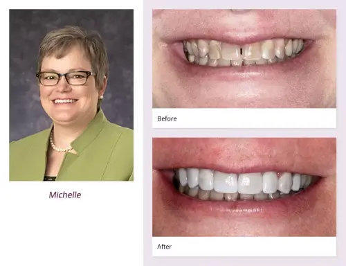 client-Michelle-before-after