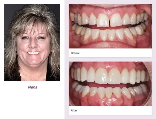 client-Nena-before-after