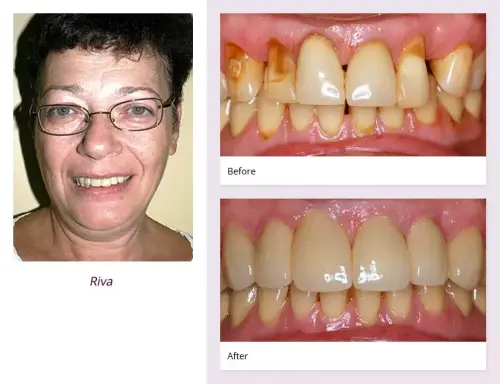 client-Riva-before-after