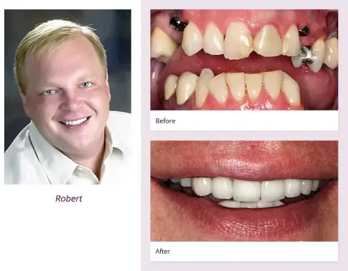 client-Robert-before-after
