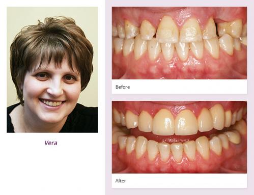 client-Vera-before-after